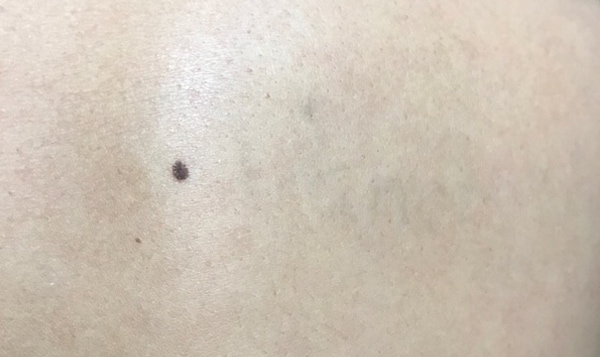 tattoo-removal-after