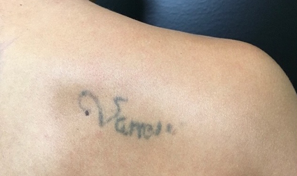 tattoo-removal-before
